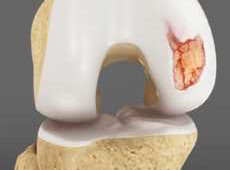 Articular Cartilage Repair